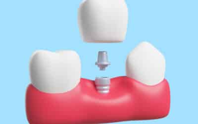Échecs tardifs en implantologie : analyse et prévention des complications