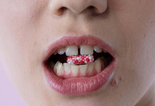 stress dents