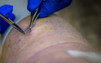 Kyste odontogène : diagnostic et chirurgie esthétique