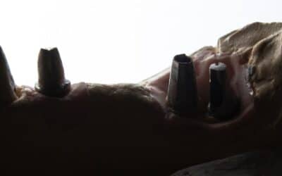 Prix All-on-4 et All-on-6 2026 : Tarifs Édentement Complet | Cabinet Eragny