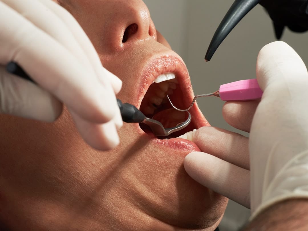 Caries et Risques Cardiovasculaires : Protégez Votre Cœur