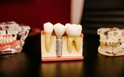 Implants dentaires adulte : esthétique et fonction réunies