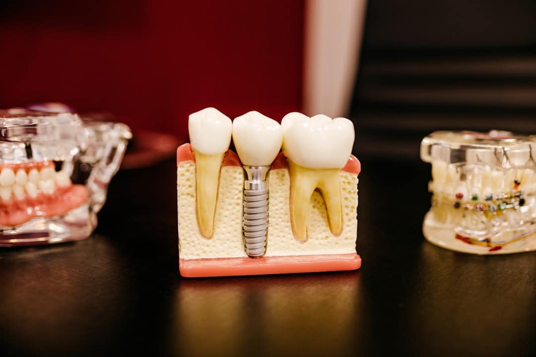 Implants dentaires adulte : esthétique et fonction réunies